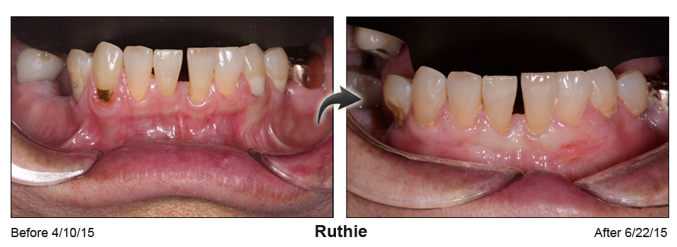 Before and Afte picture